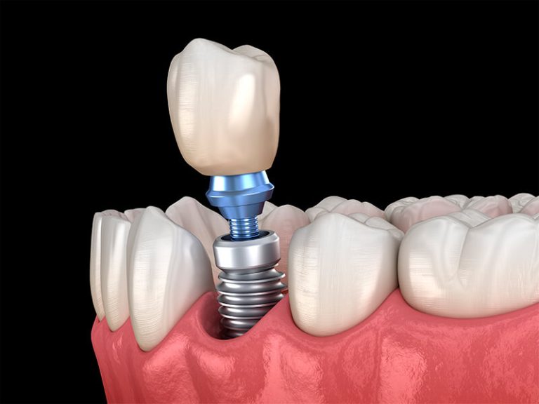 Implante dentário com pilar e coroa, componente de contorno fino medido em máquina de medição óptica