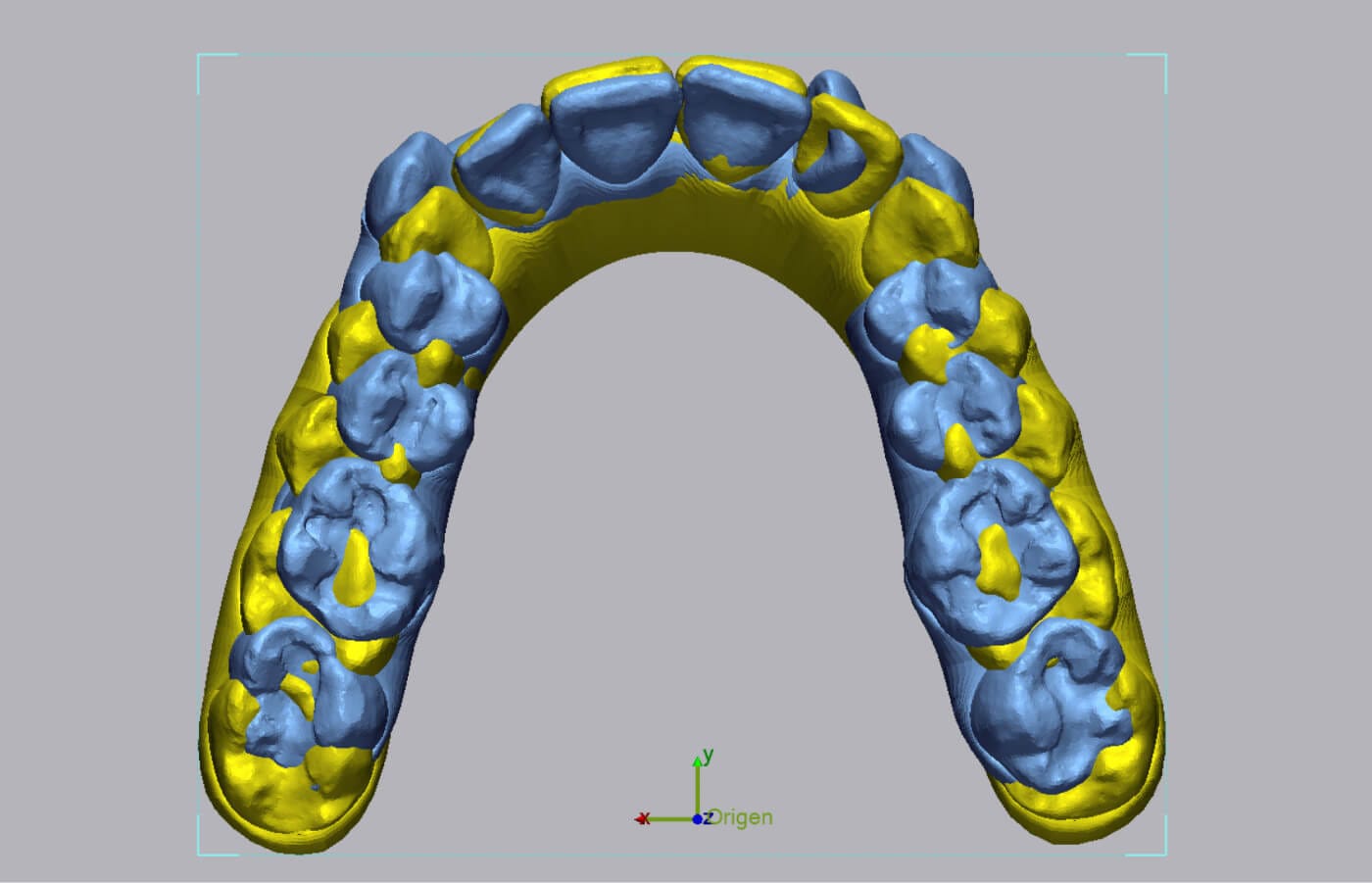 Duas digitalizações 3D de arcada dentária sobrepostas no Geomagic Control X para comparar a evolução do tratamento